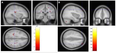 Therapeutic Effect of Repetitive Transcranial Magnetic Stimulation for Post-stroke Vascular Cognitive Impairment: A Prospective Pilot Study